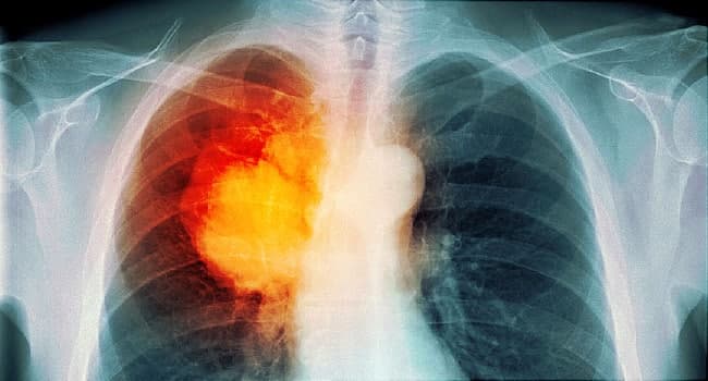 650X350 Lung Cancer Overview Slideshow